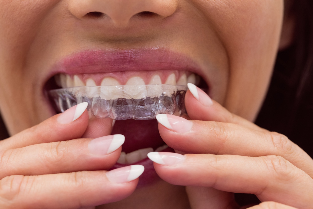 Invisalign ve geleneksel diş telleri karşılaştırması